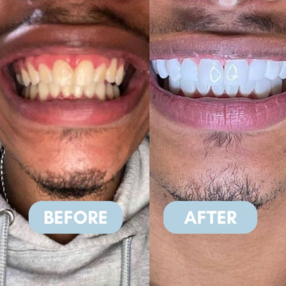 Whitening Strips